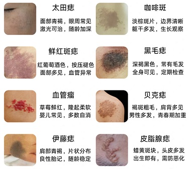 宝宝胎记多大年龄治疗合适？南京胎记医院哪家好？