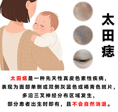 南京治疗太田痣哪里靠谱？太田痣激光几次能去除？